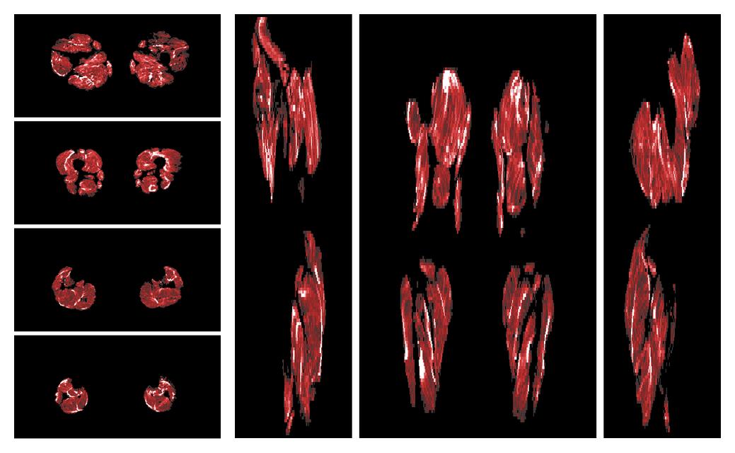 Muscle fiber tract density map based on whole leg DTI based fiber tractography.