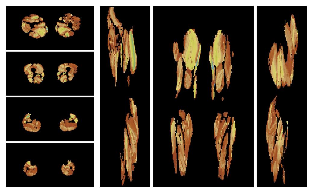 Muscle fiber tract length map based on whole leg DTI based fiber tractography.