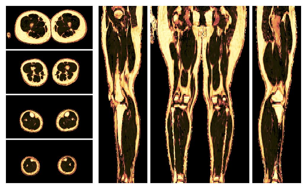 The fat fraction of the lower extremity obtained from the dixon reconstruction for muscle water fat quantification.