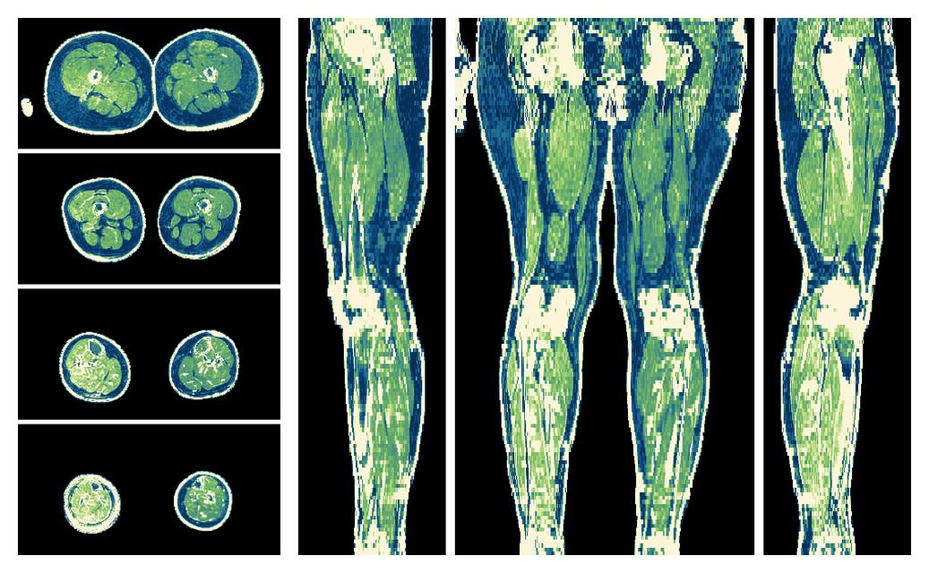 The R2 star relaxation time of the lower extremity obtained from the dixon reconstruction for muscle water fat quantification.