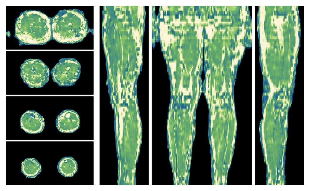 The water only T2 relaxation time of the lower extremity obtained from multi echo spin echo t2 mapping with EPG based reconstruction.