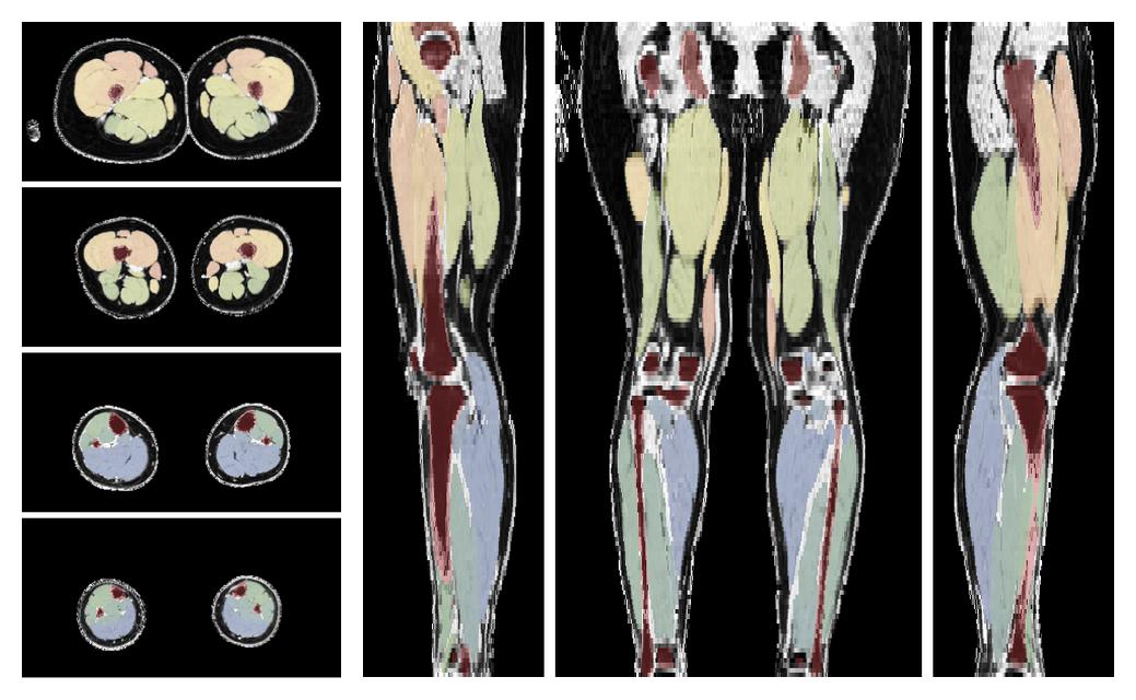 Overlay of automated muscle segmentation labels on dixon water image.