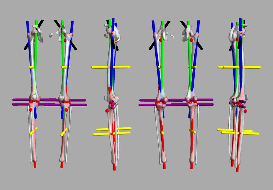 3D render of automated bone segmentation and force lines.