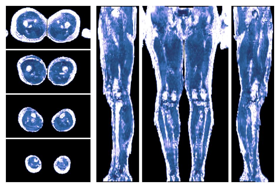 IVIM corrected whole leg muscle fractional anisotropy obtained from diffusion tensor imaging.