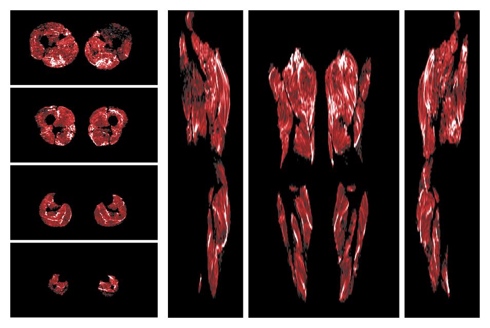 Muscle fiber tract density map based on whole leg DTI based fiber tractography.