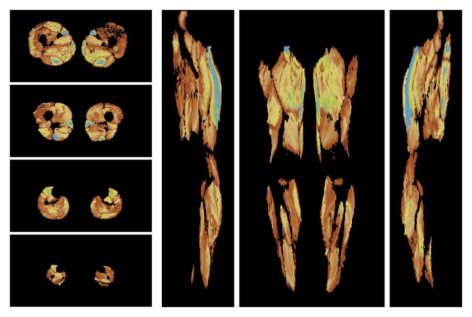 Muscle fiber tract length map based on whole leg DTI based fiber tractography.