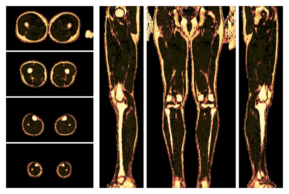 The fat fraction of the lower extremity obtained from the dixon reconstruction for muscle water fat quantification.