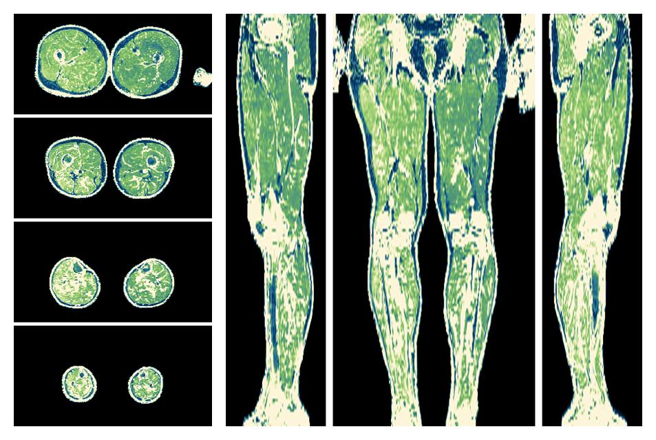 The R2 star relaxation time of the lower extremity obtained from the dixon reconstruction for muscle water fat quantification.