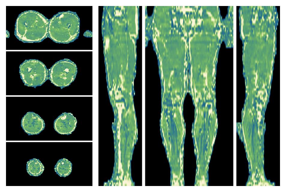 The water only T2 relaxation time of the lower extremity obtained from multi echo spin echo t2 mapping with EPG based reconstruction.