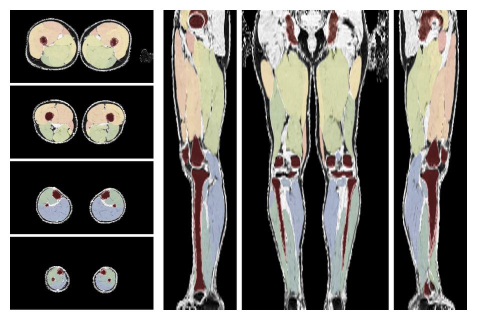 Overlay of automated muscle segmentation labels on dixon water image.