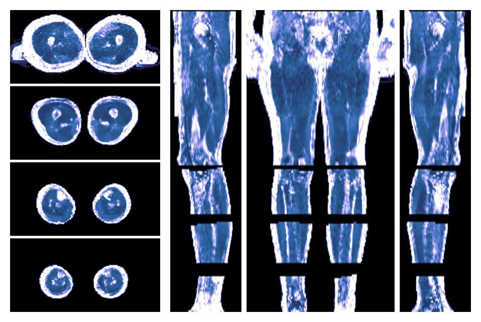 IVIM corrected whole leg muscle fractional anisotropy obtained from diffusion tensor imaging.