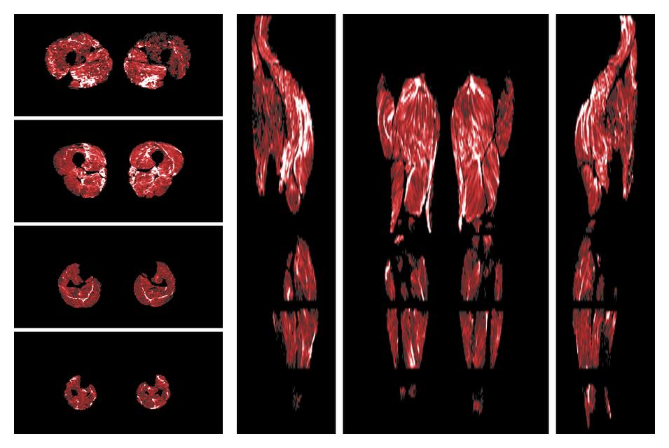 Muscle fiber tract density map based on whole leg DTI based fiber tractography.