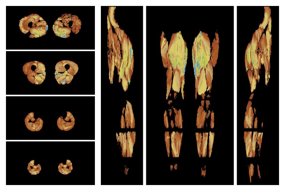 Muscle fiber tract length map based on whole leg DTI based fiber tractography.