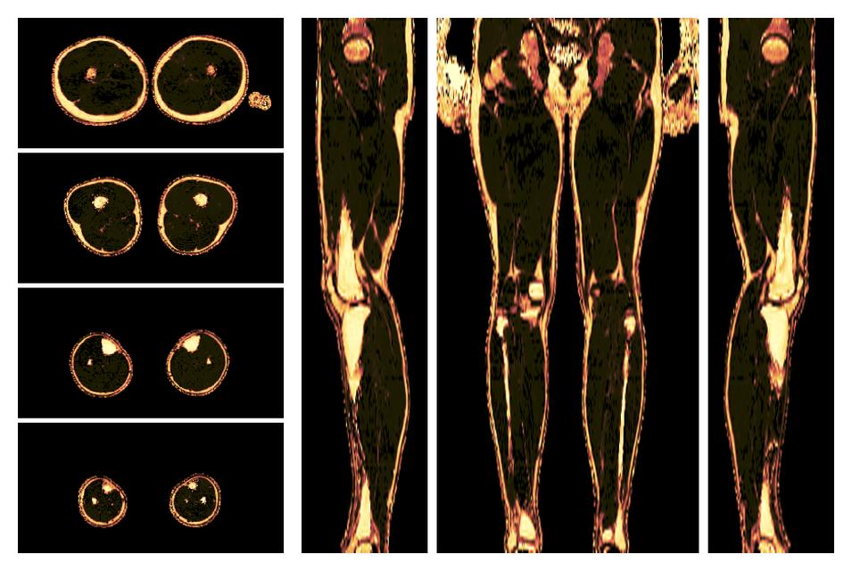 The fat fraction of the lower extremity obtained from the dixon reconstruction for muscle water fat quantification.