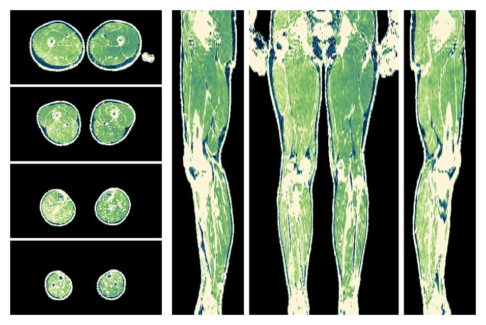 The R2 star relaxation time of the lower extremity obtained from the dixon reconstruction for muscle water fat quantification.