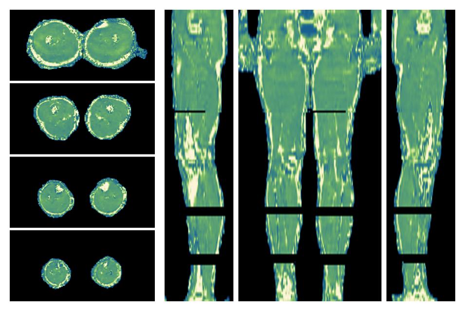 The water only T2 relaxation time of the lower extremity obtained from multi echo spin echo t2 mapping with EPG based reconstruction.