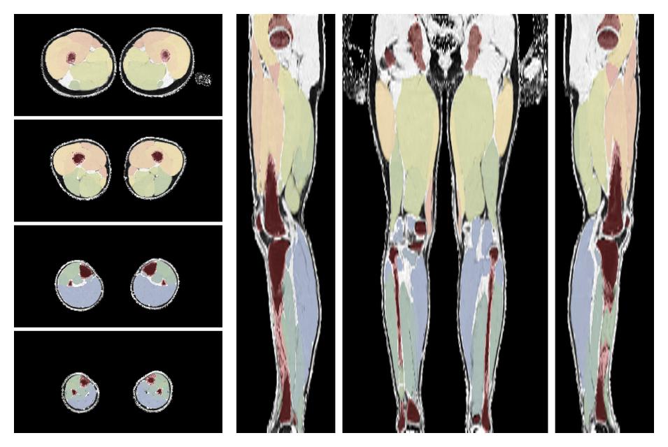 Overlay of automated muscle segmentation labels on dixon water image.