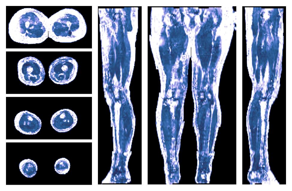 IVIM corrected whole leg muscle fractional anisotropy obtained from diffusion tensor imaging.