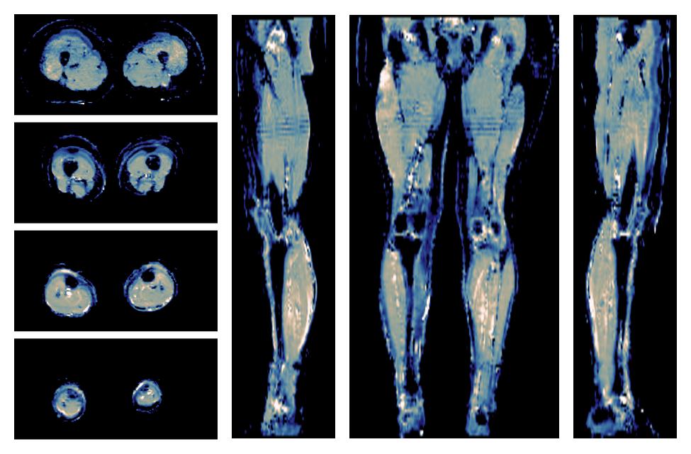 IVIM corrected whole leg muscle mean diffusivity obtained from diffusion tensor imaging.