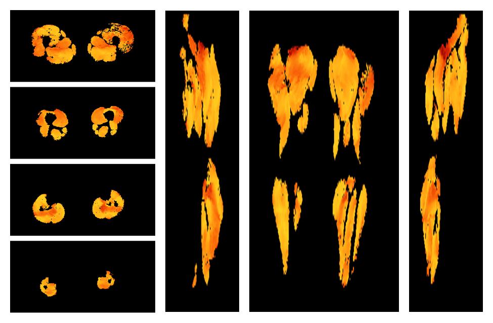 Muscle fiber tract angle map based on whole leg DTI based fiber tractography.