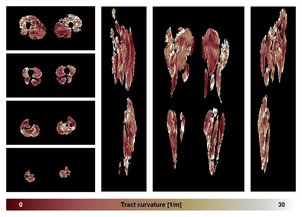 Muscle fiber tract curvature map based on whole leg DTI based fiber tractography.