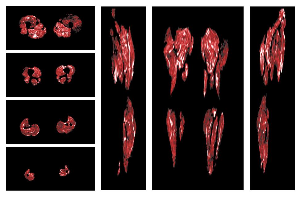 Muscle fiber tract density map based on whole leg DTI based fiber tractography.