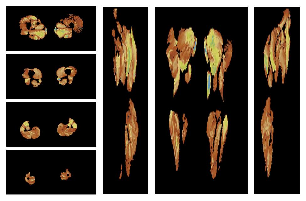 Muscle fiber tract length map based on whole leg DTI based fiber tractography.