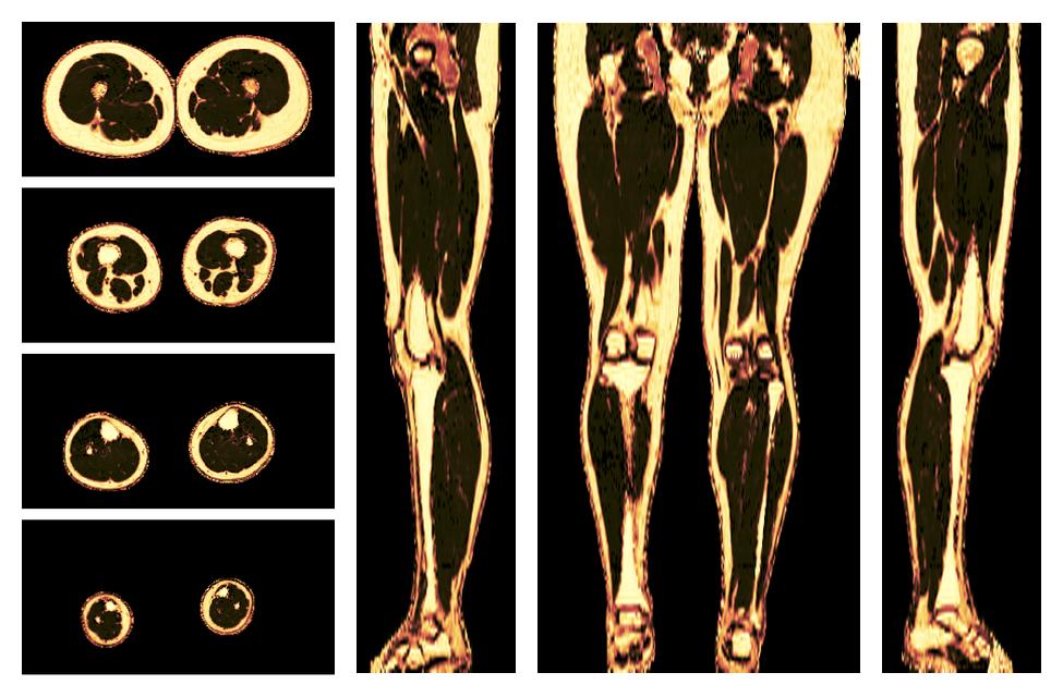 The fat fraction of the lower extremity obtained from the dixon reconstruction for muscle water fat quantification.