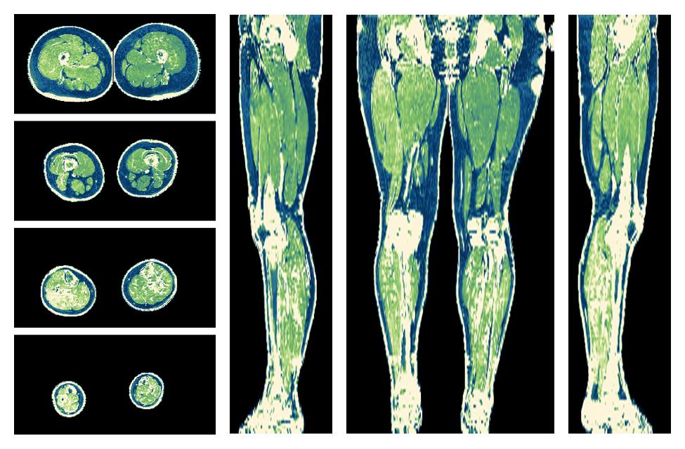 The R2 star relaxation time of the lower extremity obtained from the dixon reconstruction for muscle water fat quantification.