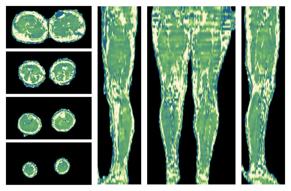 The water only T2 relaxation time of the lower extremity obtained from multi echo spin echo t2 mapping with EPG based reconstruction.