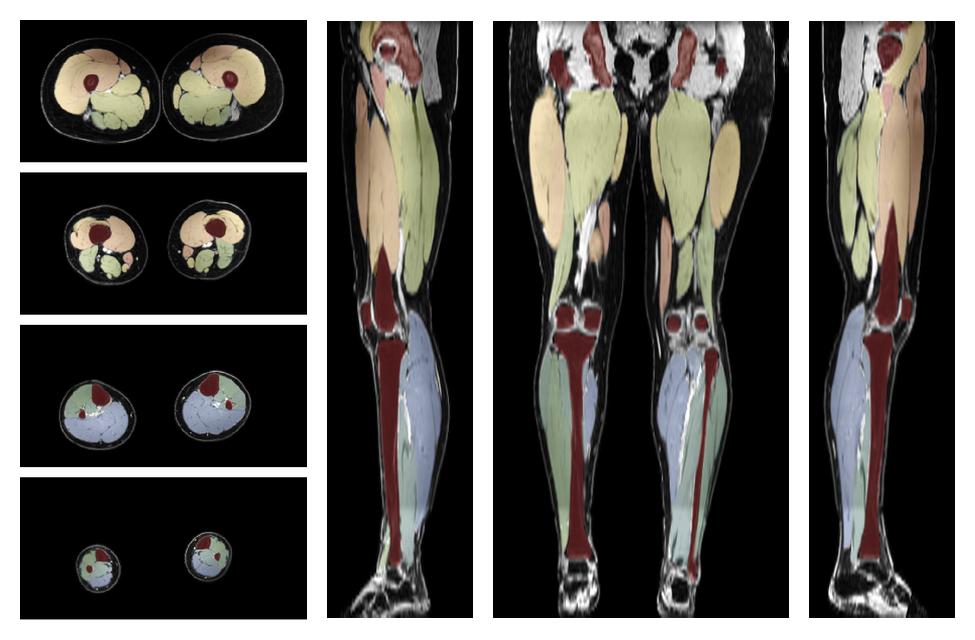 Overlay of automated muscle segmentation labels on dixon water image.