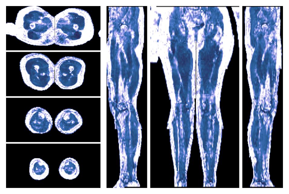 IVIM corrected whole leg muscle fractional anisotropy obtained from diffusion tensor imaging.