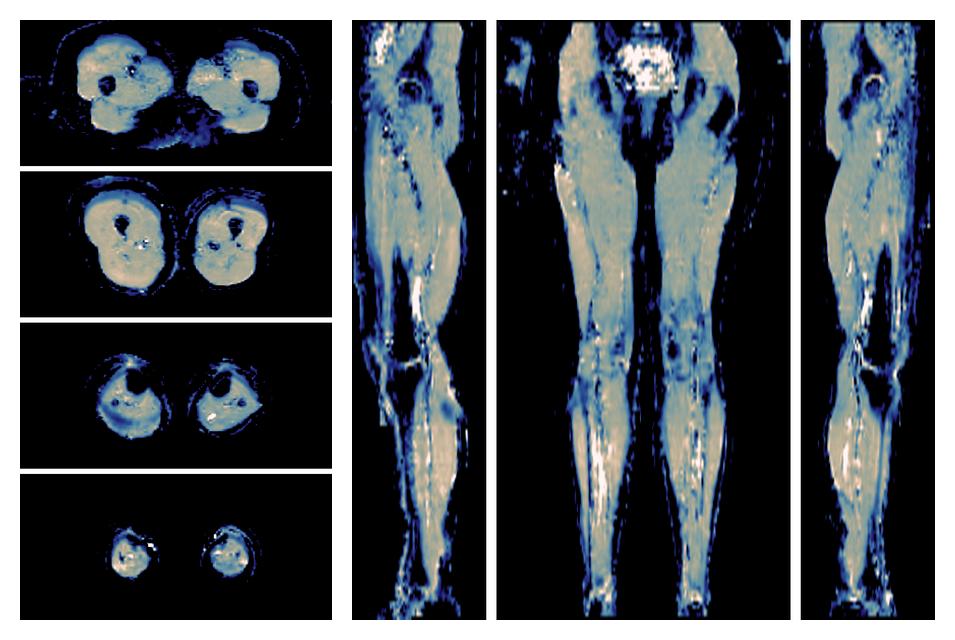 IVIM corrected whole leg muscle mean diffusivity obtained from diffusion tensor imaging.