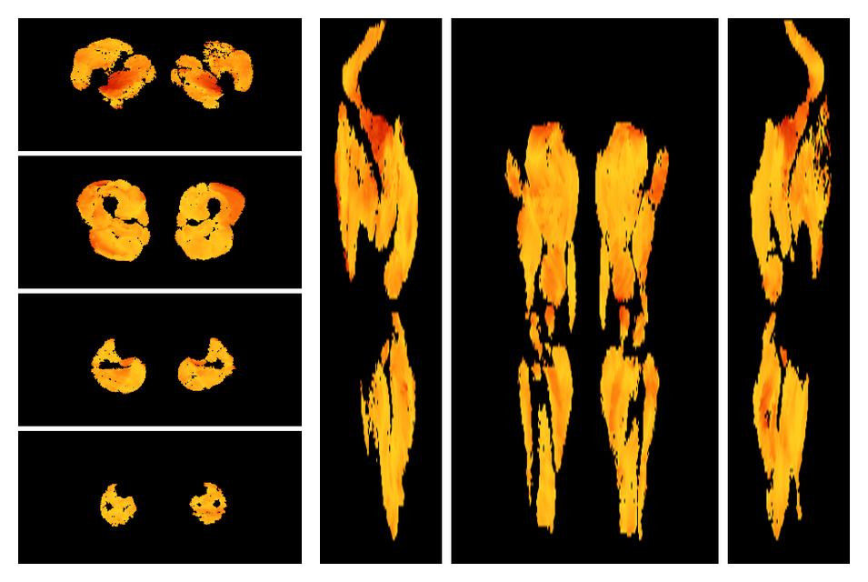 Muscle fiber tract angle map based on whole leg DTI based fiber tractography.