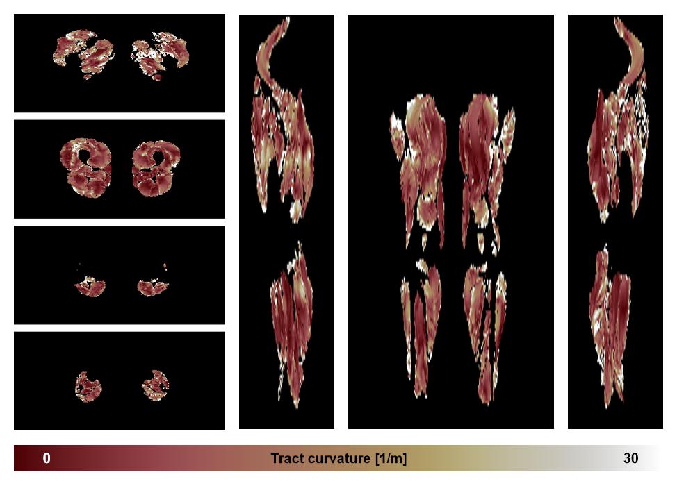 Muscle fiber tract curvature map based on whole leg DTI based fiber tractography.