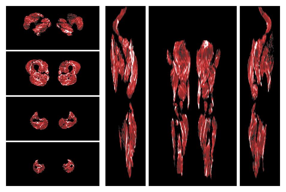 Muscle fiber tract density map based on whole leg DTI based fiber tractography.