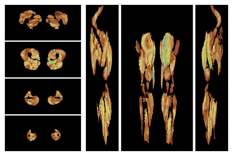 Muscle fiber tract length map based on whole leg DTI based fiber tractography.