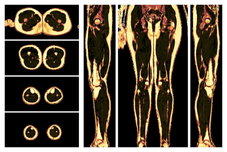 The fat fraction of the lower extremity obtained from the dixon reconstruction for muscle water fat quantification.