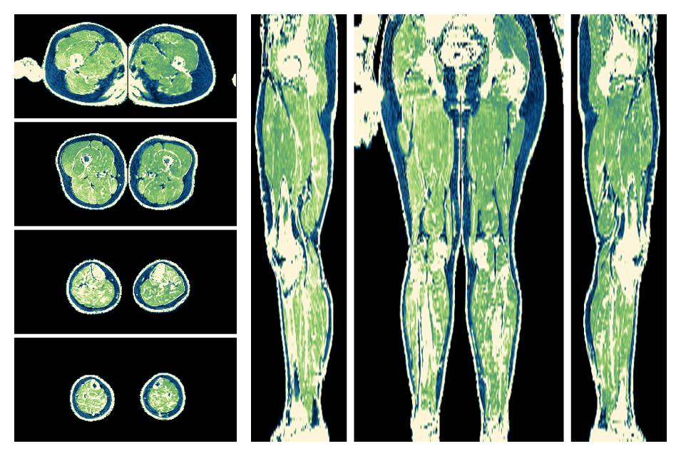 The R2 star relaxation time of the lower extremity obtained from the dixon reconstruction for muscle water fat quantification.