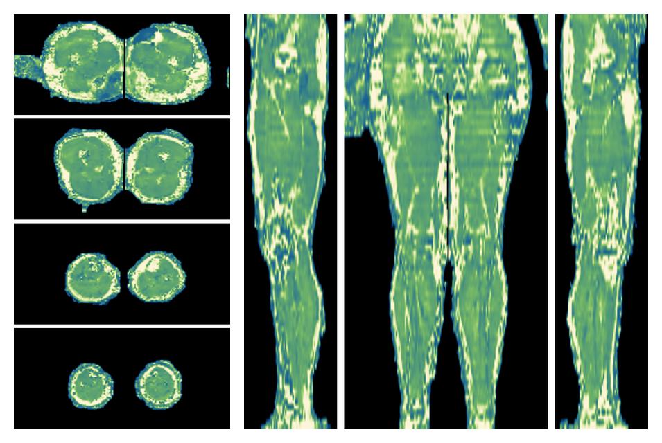 The water only T2 relaxation time of the lower extremity obtained from multi echo spin echo t2 mapping with EPG based reconstruction.