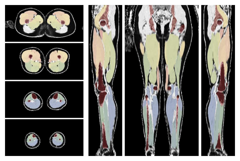 Overlay of automated muscle segmentation labels on dixon water image.