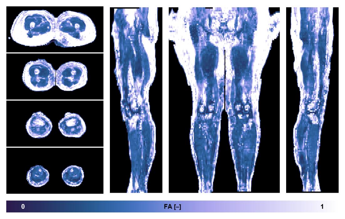 IVIM corrected whole leg muscle fractional anisotropy obtained from diffusion tensor imaging.