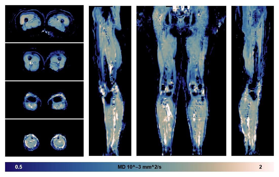 IVIM corrected whole leg muscle mean diffusivity obtained from diffusion tensor imaging.