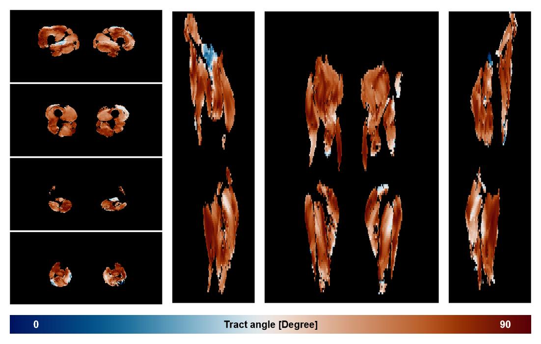 Muscle fiber tract angle map based on whole leg DTI based fiber tractography.