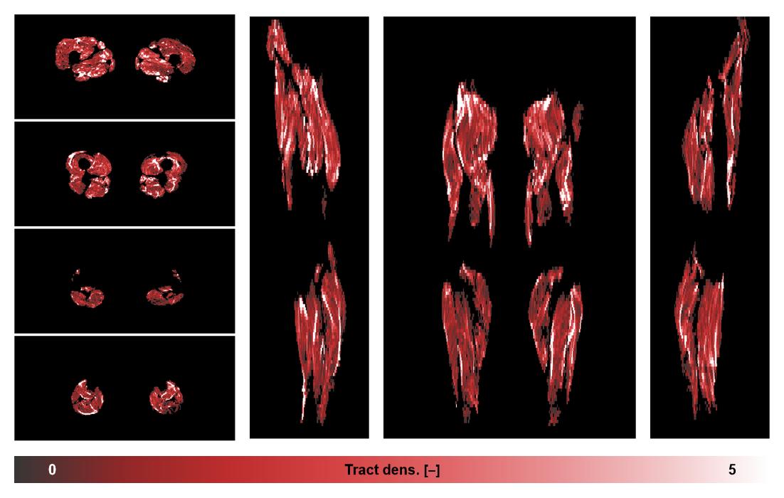 Muscle fiber tract density map based on whole leg DTI based fiber tractography.