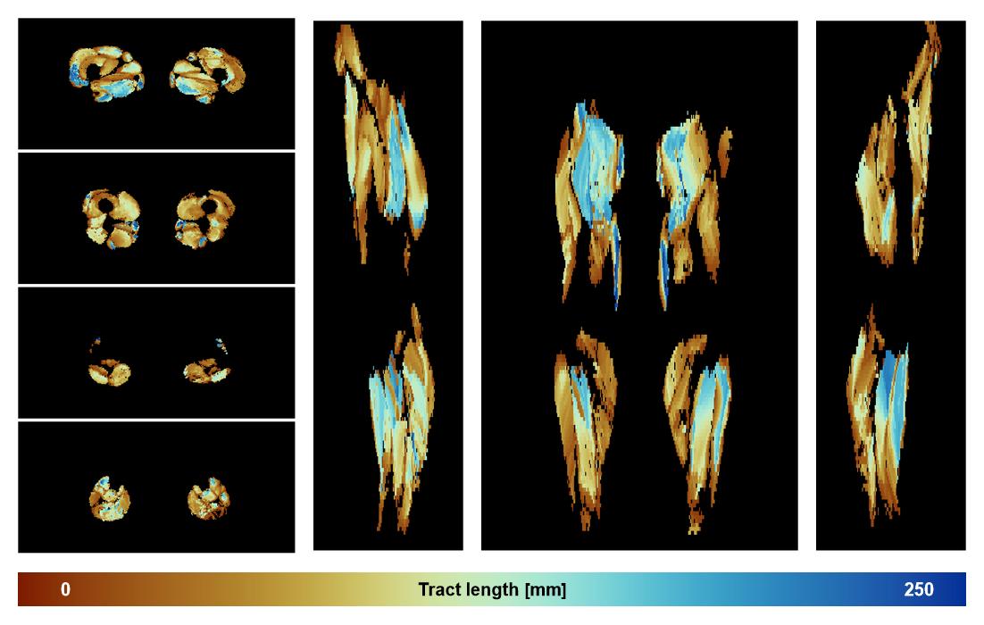 Muscle fiber tract length map based on whole leg DTI based fiber tractography.