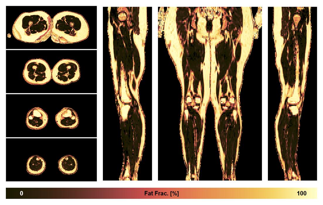 The fat fraction of the lower extremity obtained from the dixon reconstruction for muscle water fat quantification.