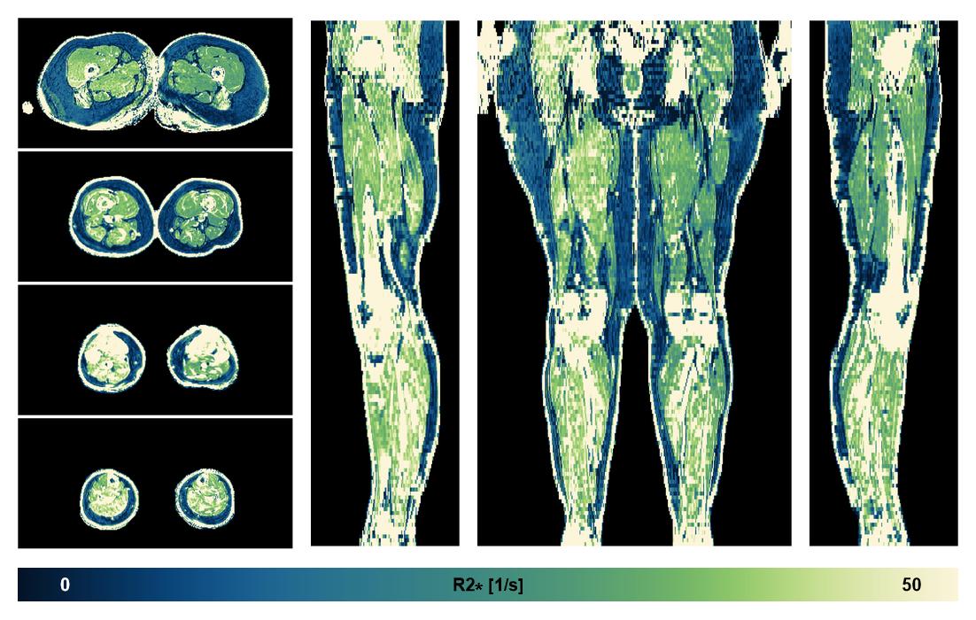 The R2 star relaxation time of the lower extremity obtained from the dixon reconstruction for muscle water fat quantification.