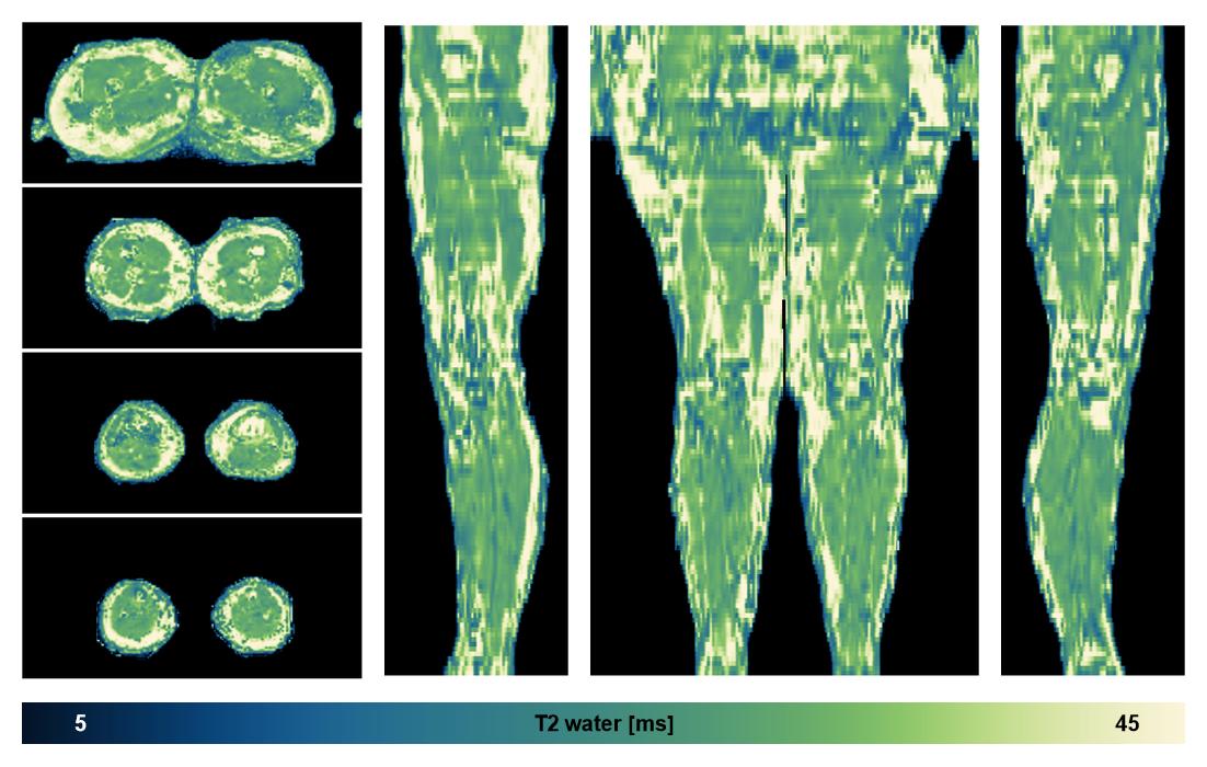 The water only T2 relaxation time of the lower extremity obtained from multi echo spin echo t2 mapping with EPG based reconstruction.