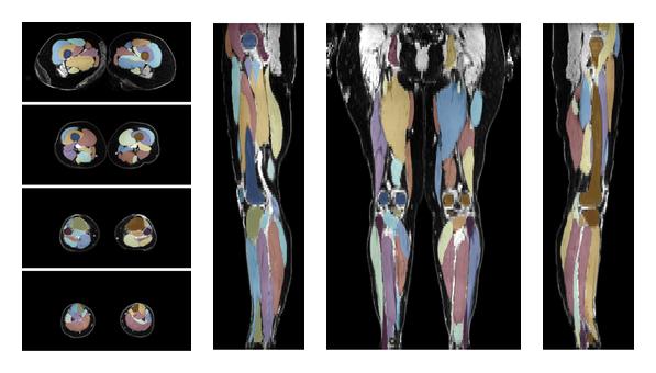 Overlay of automated muscle segmentation labels on dixon water image.